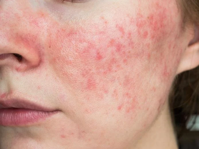 Sau treatment làn da thường rất dễ tổn thương và nhạy cảm