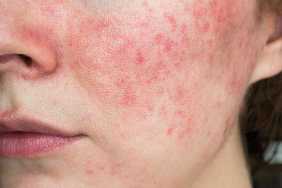 Da bị tổn thương do corticoid là tình trạng phổ biến hiện nay, gây ra nhiều hệ lụy về sức khỏe và thẩm mỹ
