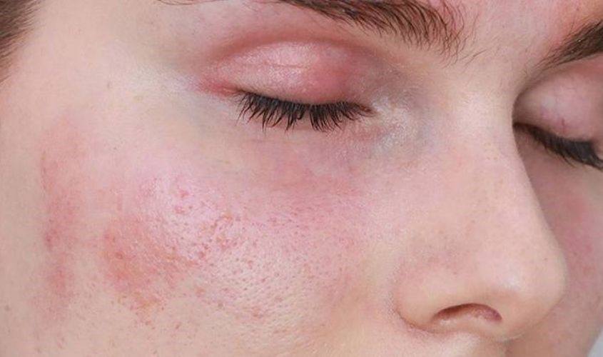 Sau quá trình treatment như lăn kim, laser hay peel da, làn da thường bị tổn thương và mất nước nghiêm trọng.