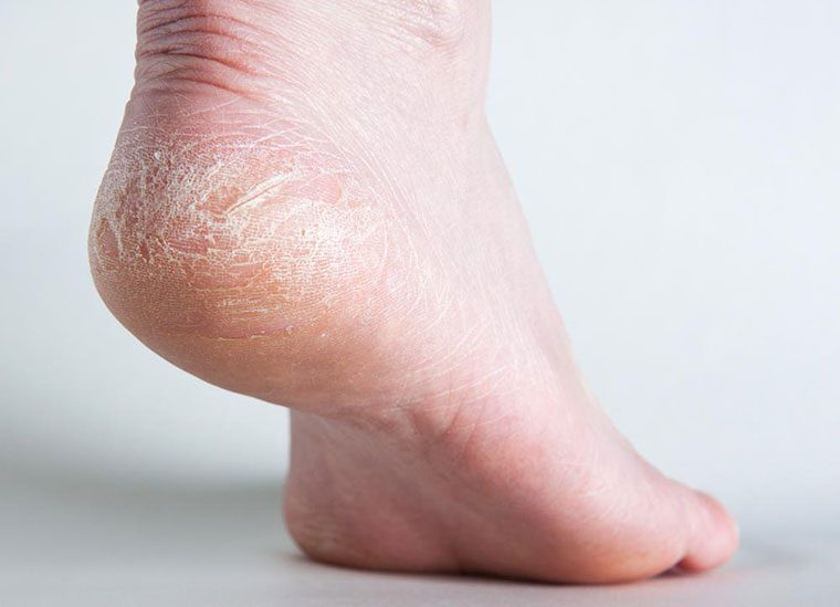 Nứt gót chân mùa đông đa phần do sự thiếu ẩm khiến da cứng, dày và dễ bong tróc.