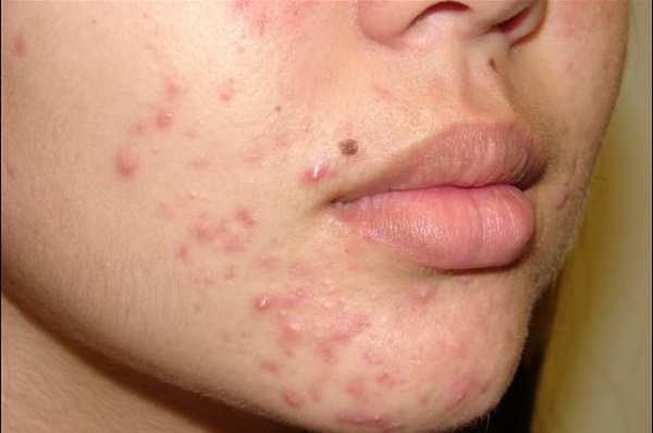 Làm thế nào để chọn được nước hoa hồng cho da mụn