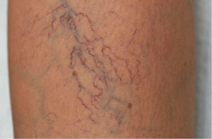 Biểu hiện của giãn mao mạch và những điều bạn cần biết