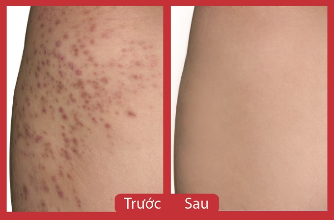 Ngăn ngừa dứt điểm viêm nang lông chỉ sau 2 tuần