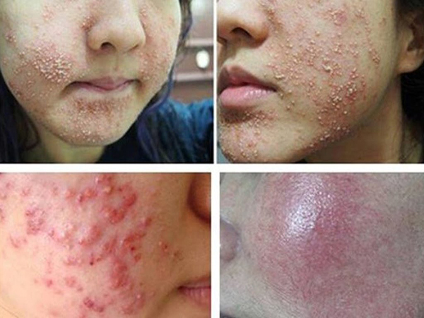 Đừng hủy hoại làn da của bạn chỉ vì tham mỹ phẩm rẻ tiền