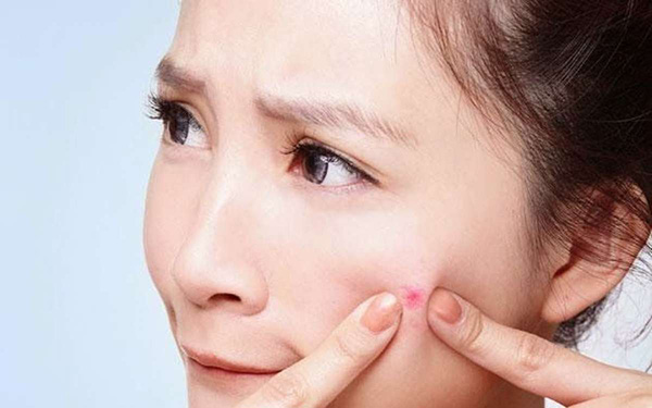 Tại sao ngăn ngừa mụn mất nhiều thời gian không cải thiện?