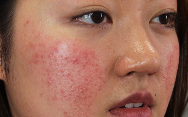 Cảnh báo các phương pháp ngăn ngừa mụn nguy hiểm cho làn da