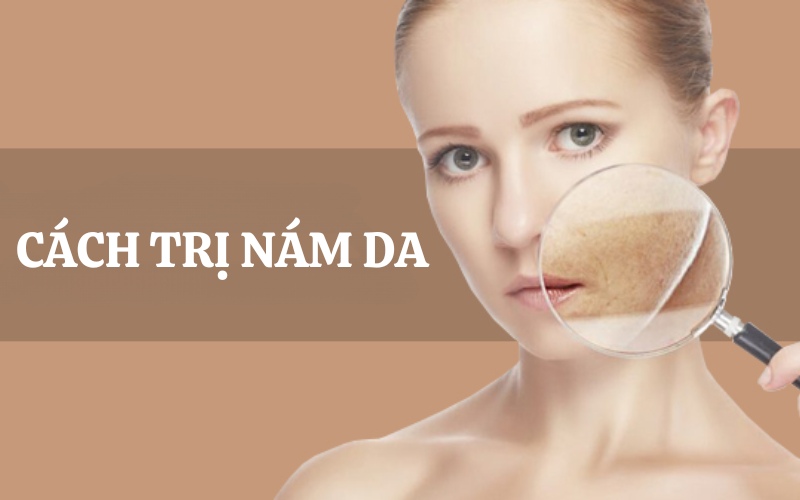 Tổng hợp 7 cách trị nám da hiệu quả, an toàn, có thể làm tại nhà