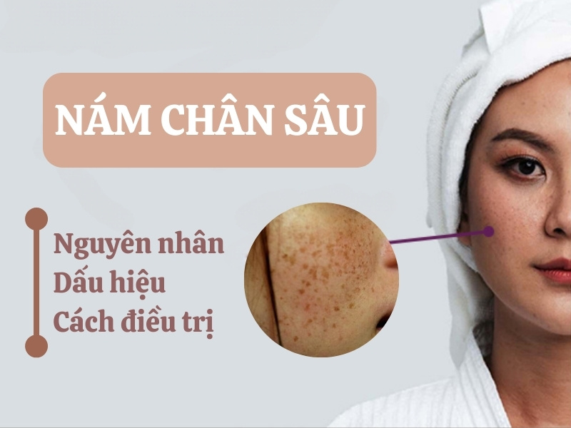 Nám chân sâu: Dấu hiệu, nguyên nhân, cách điều trị hiệu quả