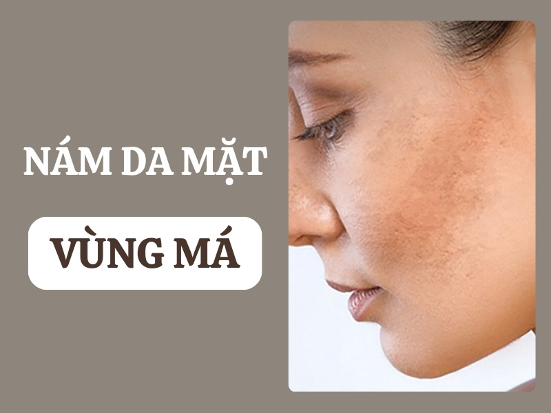 Nám da mặt vùng má do đâu và 5 cách điều trị hiệu quả nhất