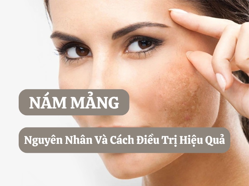 Nám mảng là gì? Nguyên nhân gây nám, cách điều trị tốt nhất