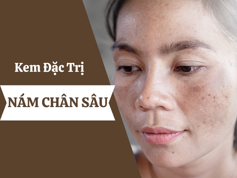 Top 3 kem đặc trị nám chân sâu được chuyên gia khuyên dùng