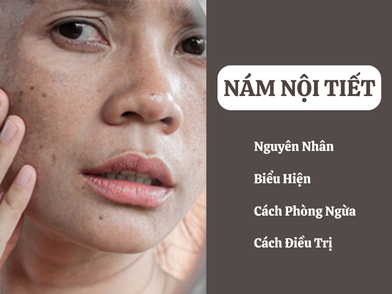 Nám nội tiết là gì? Nguyên nhân, triệu chứng và cách điều trị