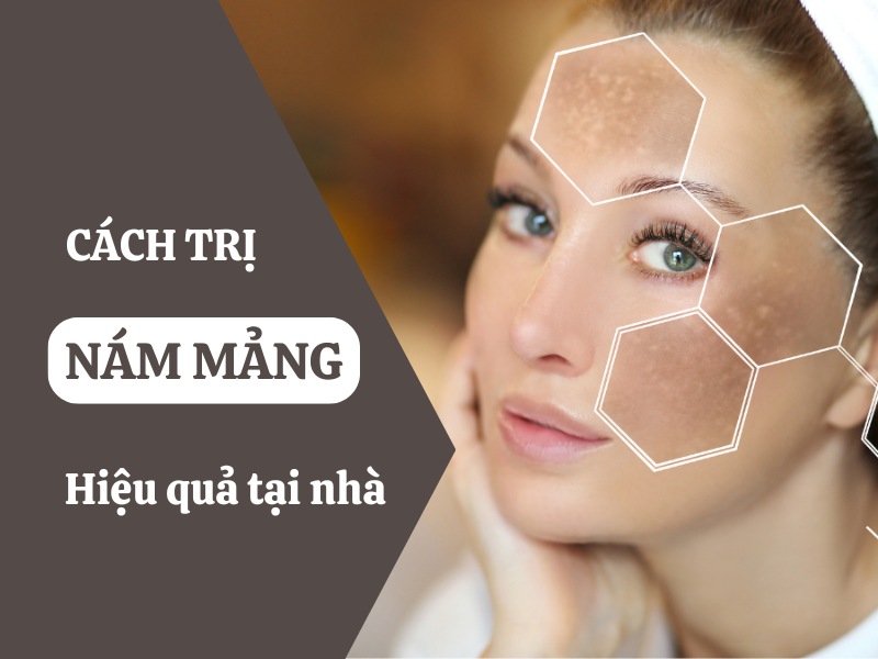 5+ Cách trị nám mảng hiệu quả tại nhà bạn nên thử ngay