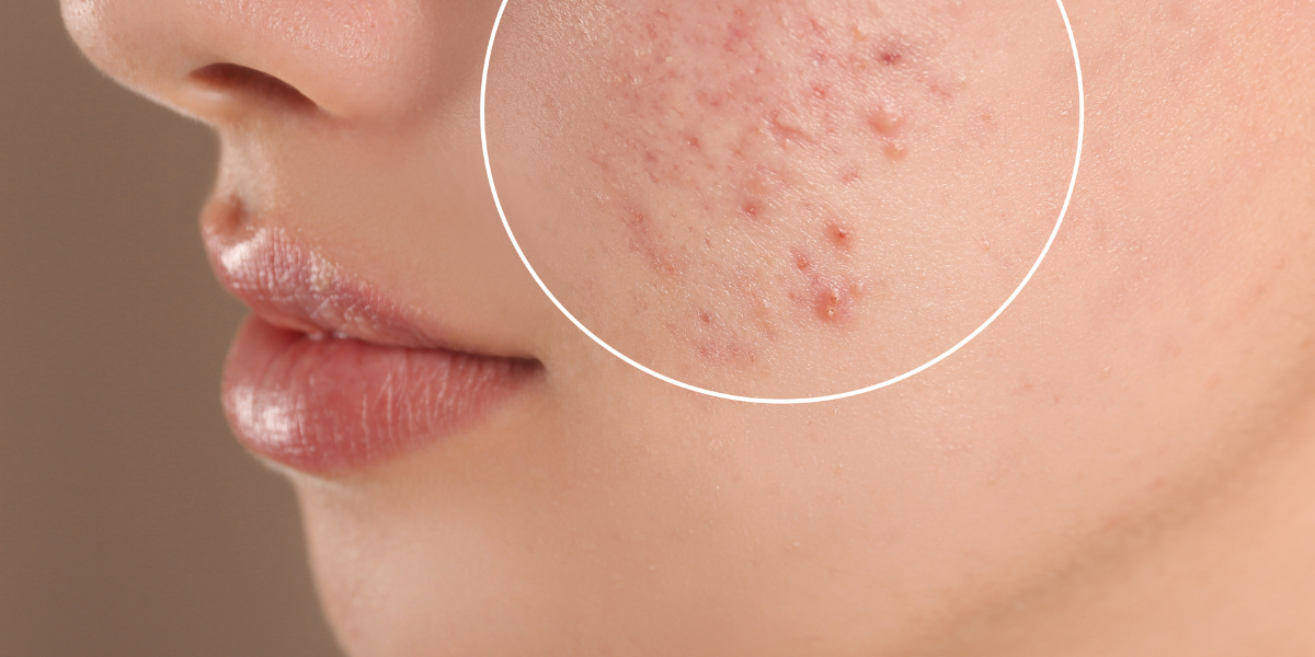 5 nguyên tắc chăm sóc da sau nặn mụn tại nhà nhất định phải nhớ