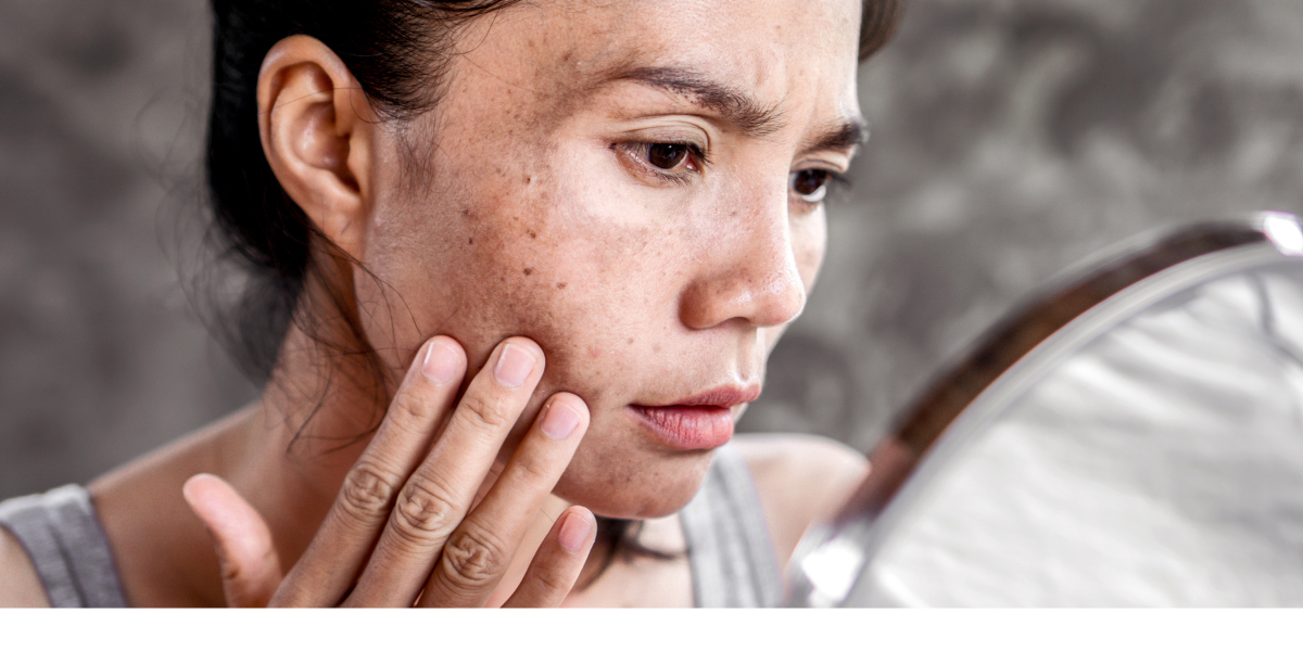 7 Cách trị nám da mặt lâu năm tại nhà hiệu quả nhất bạn nên biết