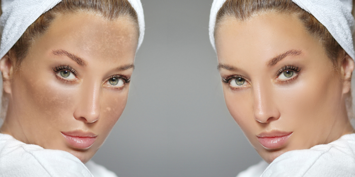 Chăm sóc da sau khi trị nám bằng laser giúp da nhanh chóng phục hồi