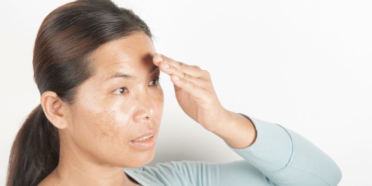 Đặt vòng tránh thai có bị nám da không? Chia sẻ từ chuyên gia