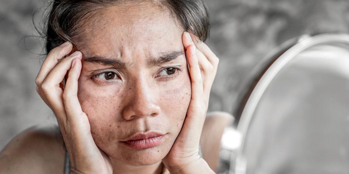 Lăn kim trị nám nên hay không? Ưu điểm và tác hại của phương pháp này