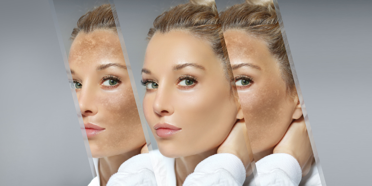 Trị nám ở đâu tốt nhất Hà Nội? Top 5 địa chỉ uy tín, hiệu quả nhất