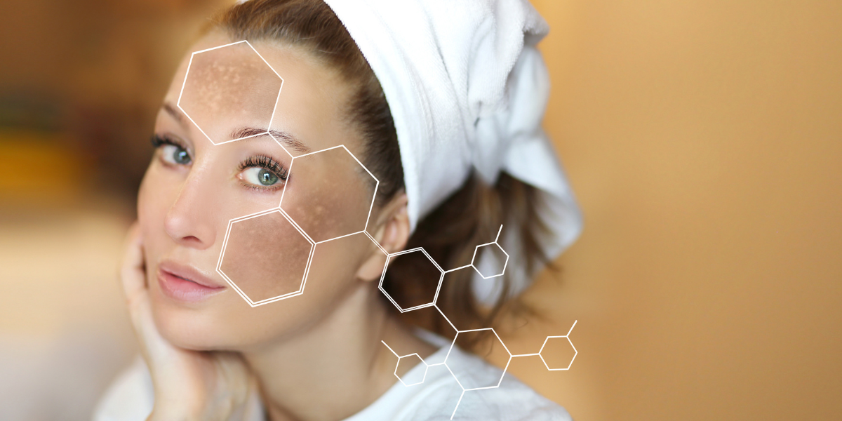 6 cách chữa nám má tại nhà đơn giản, hiệu quả nhanh chóng