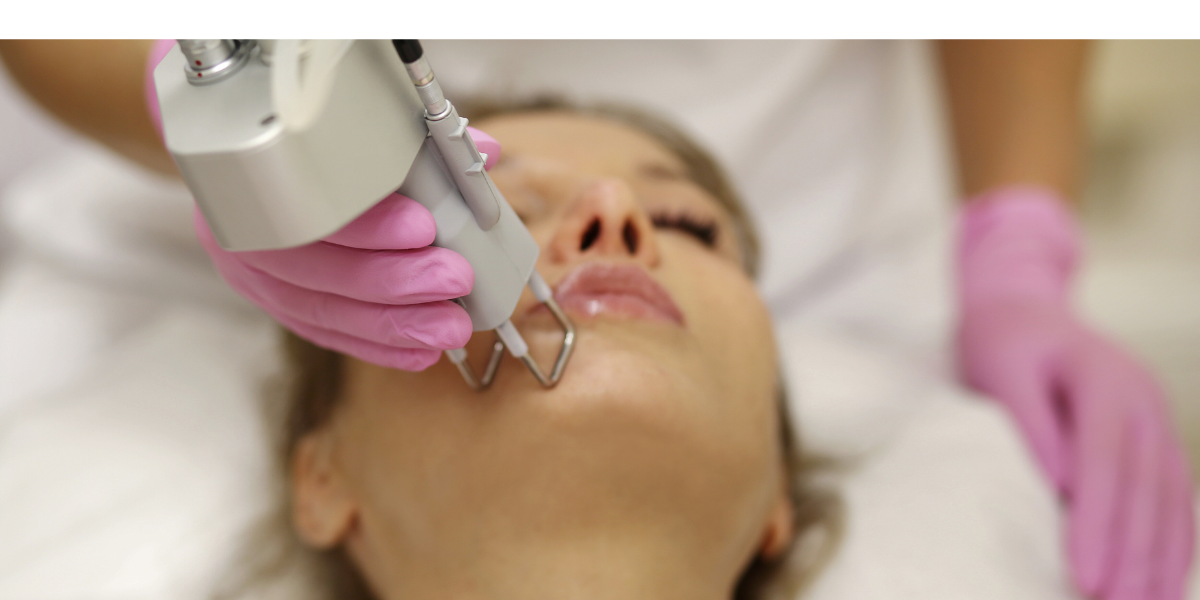 Điều trị nám bằng laser có hiệu quả không? Giá bao nhiêu?