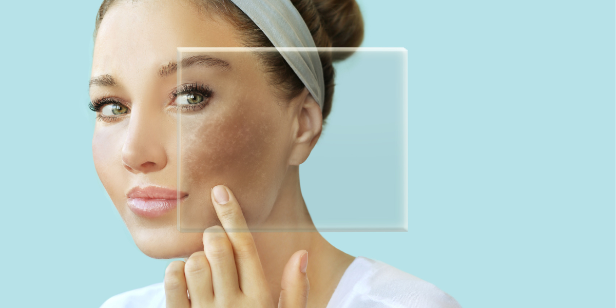 Top 3 mỹ phẩm điều trị nám nội tiết tại nhà hiệu quả cao nhất