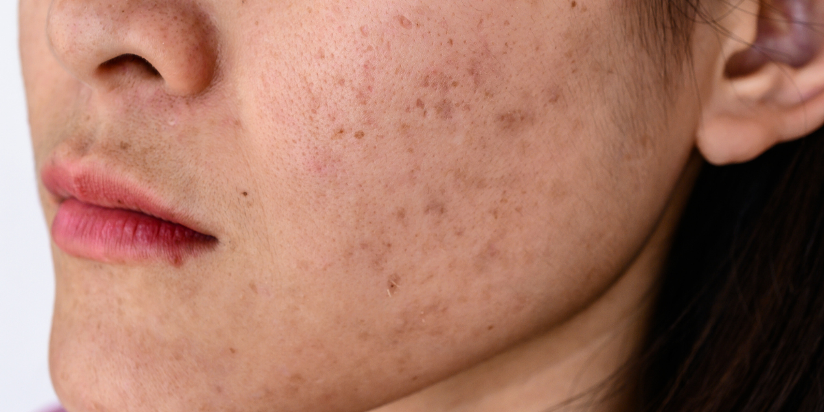 TOP 5 cách trị nám chân sâu tại nhà an toàn, hiệu quả nhất hiện nay