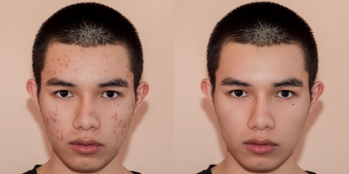 Top 5 Spa trị mụn cho nam tại Hà Nội uy tín chất lượng nhất