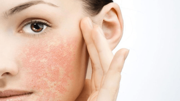 Da nhạy cảm dễ tổn thương cần phục hồi: Giải pháp hiệu quả