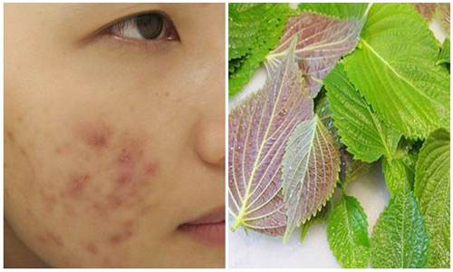 Cách trị mụn bằng tía tô đơn giản, hiệu quả tại nhà