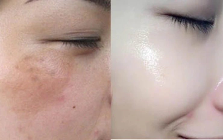 [Chuyên gia phân tích] Có nên peel da trị nám tại nhà không?