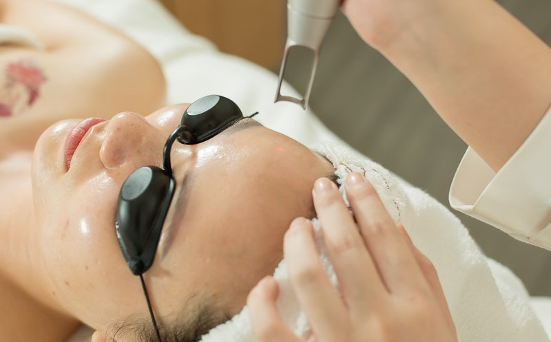 [Chuyên gia giải đáp] Laser trị nám có hết vĩnh viễn không?