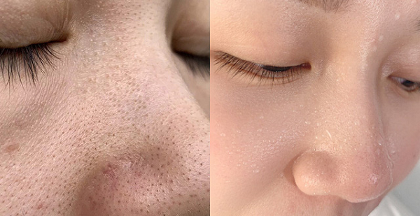 5 Cách tống cổ mụn đầu đen ở má nhanh chóng, an toàn với sản phẩm  Dr.Spiller - dr_spiller