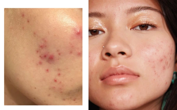 Nặn mụn xong nên làm gì để không bị thâm? 6 bước chăm sóc giảm thâm mụn với sản phẩm Dr.Spiller