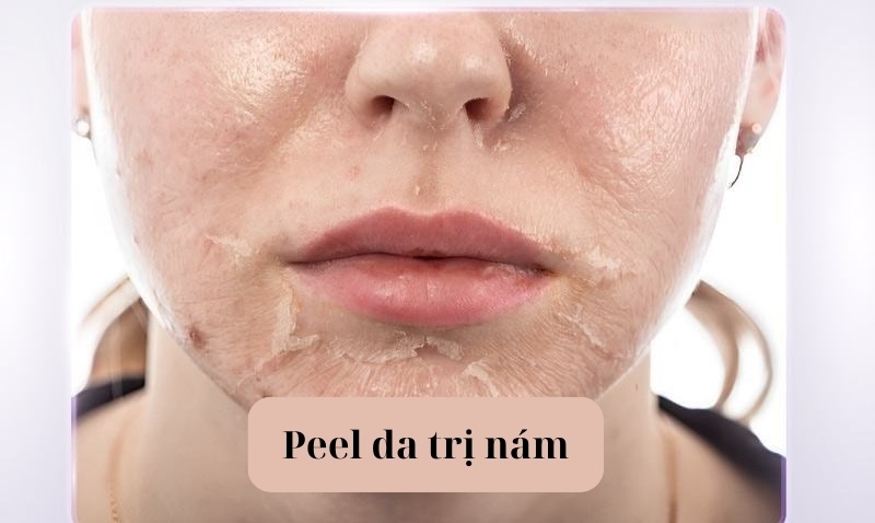 Peel da trị nám có hiệu quả không? Giải đáp chi tiết từ chuyên gia