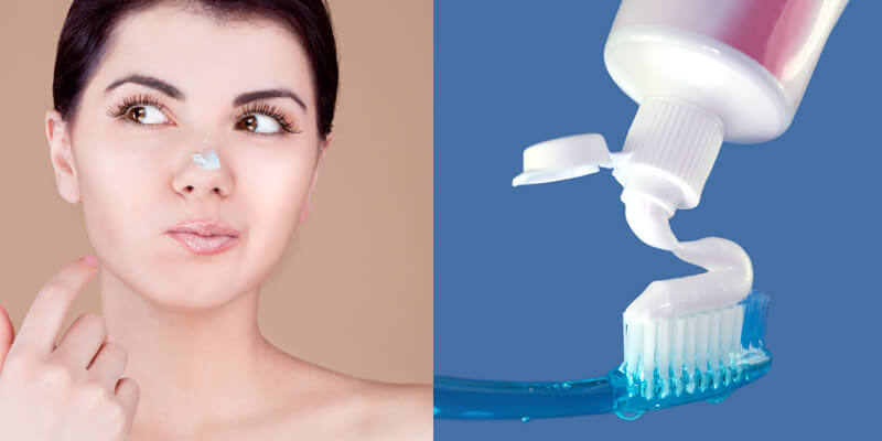Trị mụn ẩn bằng kem đánh răng – Lời đồn hay giải pháp? Góc nhìn chuyên gia da liễu