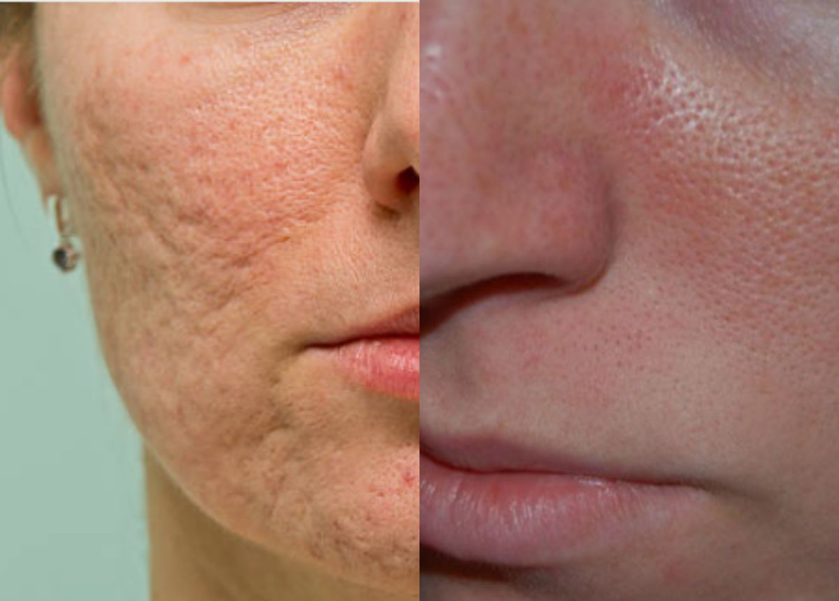 3 Cách chữa lỗ chân lông to trên mặt nhanh chóng, an toàn