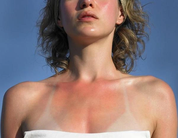 3 Cách làm dịu da nhạy cảm khi bị cháy nắng hiệu quả với sản phẩm Dr.Spiller