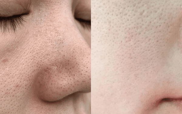 3 Cách trị mụn đầu đen và lỗ chân lông to hiệu quả tại nhà