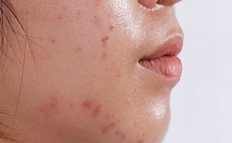 [Chuyên gia lý giải] Da dầu có cần dưỡng ẩm vào mùa hè không?