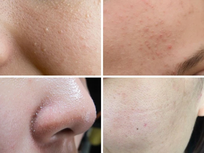 Da mặt lỗ chân lông to phải làm sao? 3 Giải pháp chuyên sâu cho da lỗ chân lông to