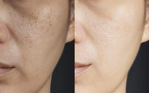 Da mặt nhờn lỗ chân lông to phải làm sao để cải thiện?