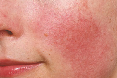 Da nhạy cảm nổi mẩn khi nắng nóng: 3 Cách xử lý và chăm sóc tại nhà