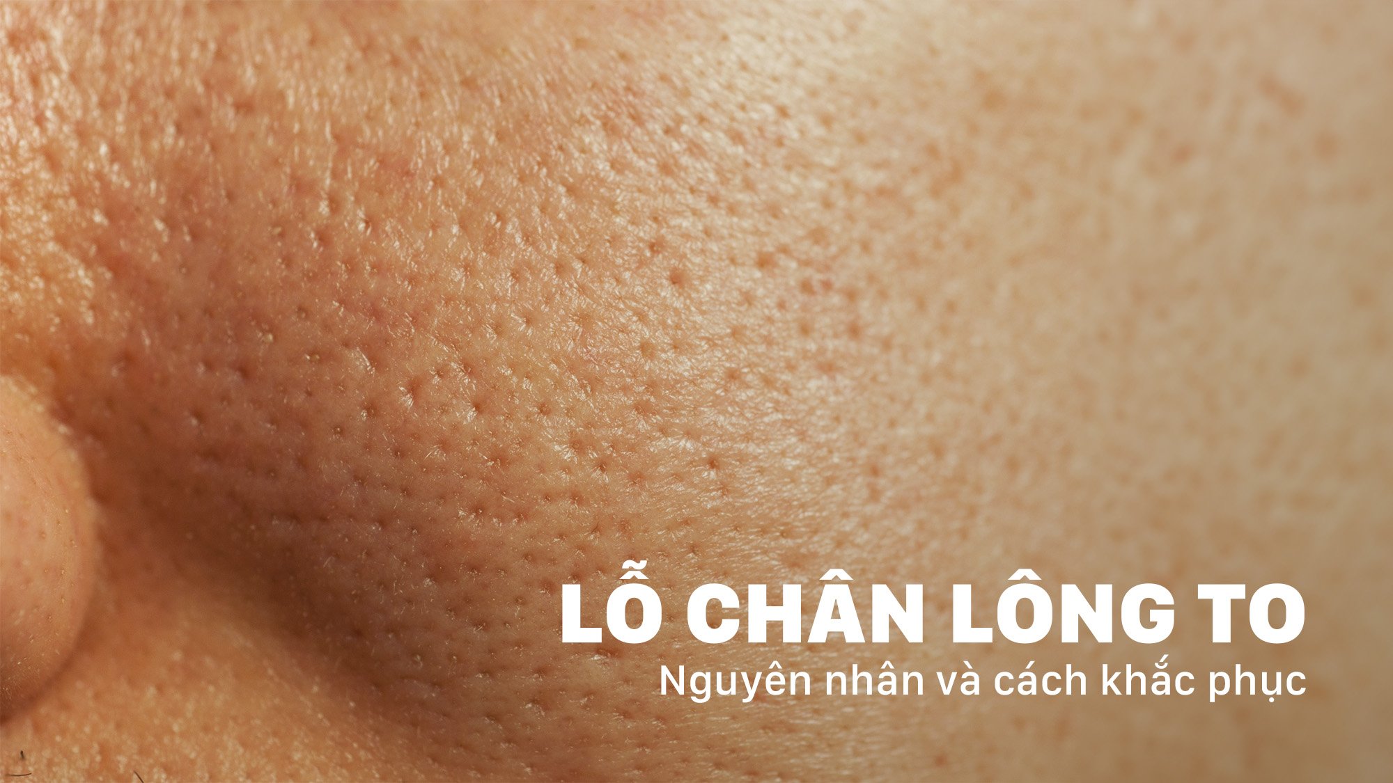 3 Cách khắc phục lỗ chân lông to hiệu quả và an toàn nhất
