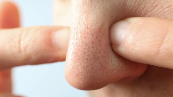 5 Giải pháp se khít lỗ chân lông to ở mũi hiệu quả tại nhà