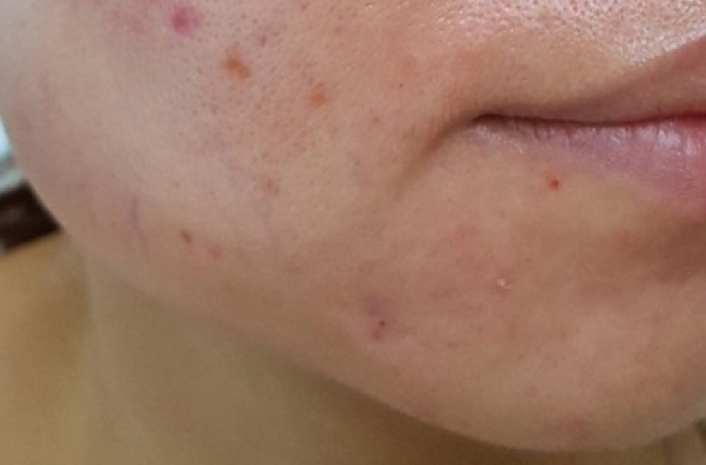 3 Cách Trị lỗ chân lông to cho da nhờn hiệu quả, an toàn, chuẩn y khoa