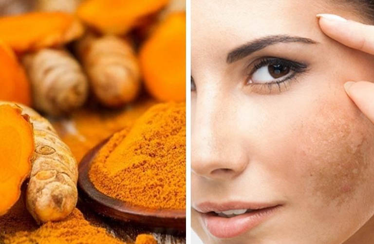 5 Cách trị nám bằng nghệ tươi hiệu quả, an toàn cho da