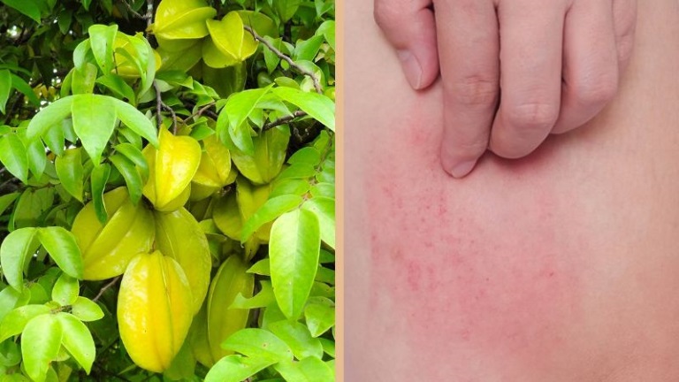 3 Mẹo dân gian giúp da nhạy cảm bớt mẩn ngứa hiệu quả