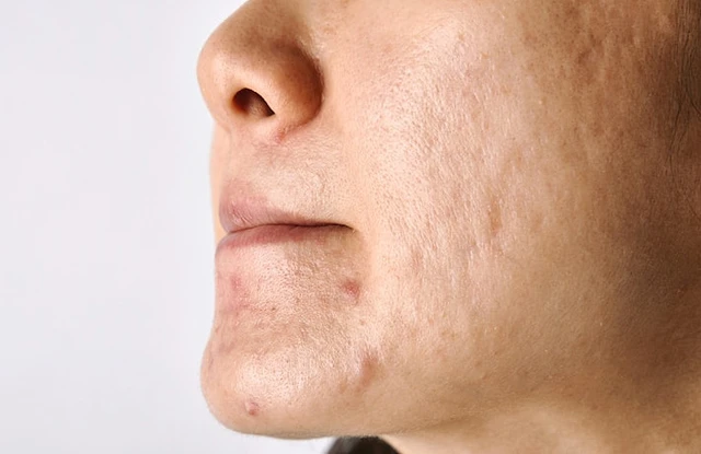 Serum trị sẹo rỗ và lỗ chân lông to: 3 Giải pháp tái tạo làn da toàn diện