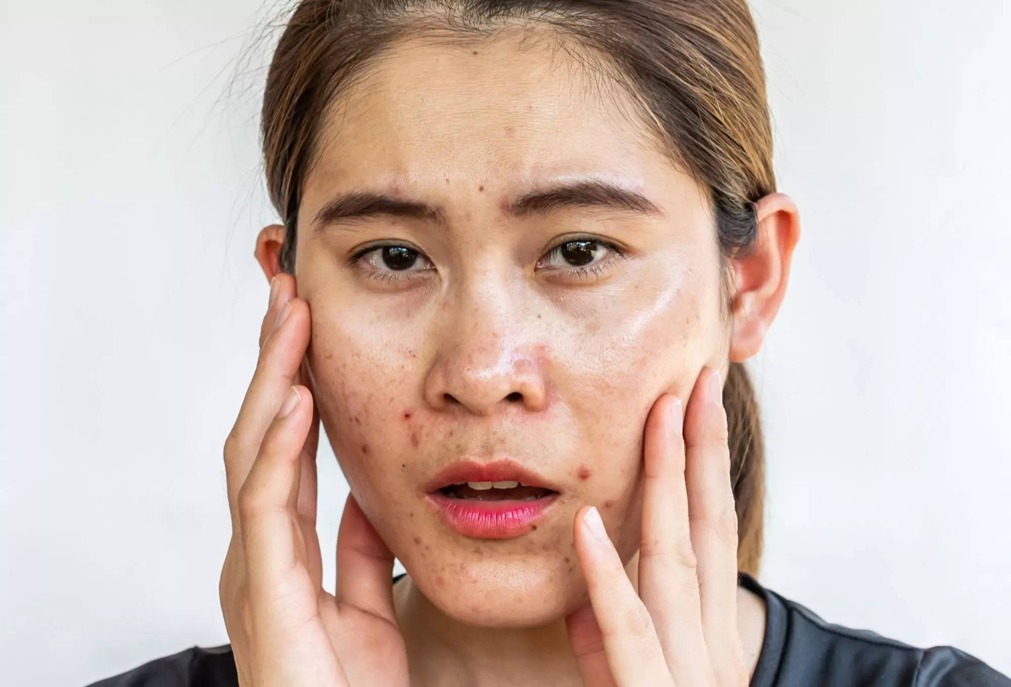 3 Cách khắc phục da nhiều dầu hiệu quả tại nhà